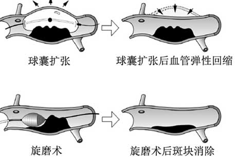 旋磨術(shù)示意圖.jpg